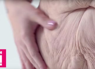 Living With Loose Skin: The Naked Truth